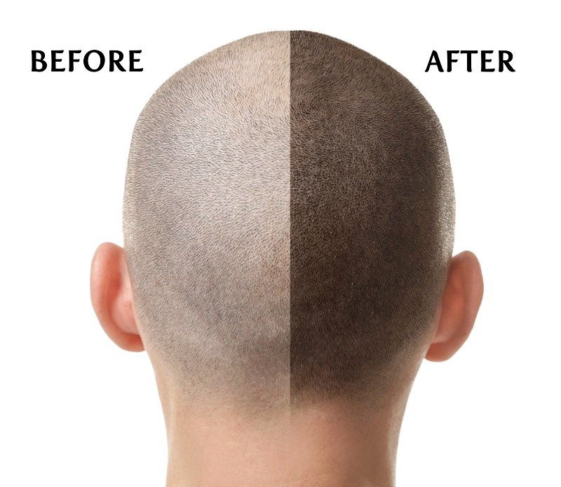 the scalp micropigmentation process