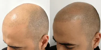 Aftercare for Scalp Micropigmentation