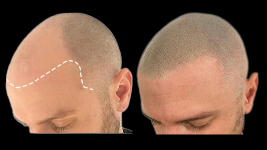 The Benefits of Scalp Micropigmentation